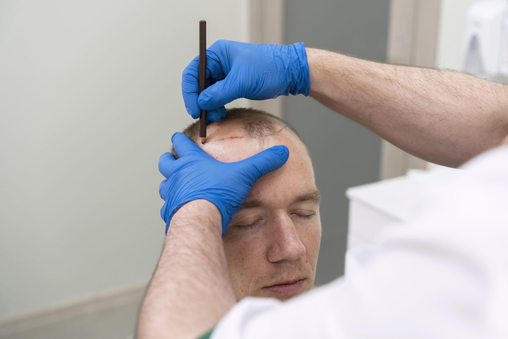 La greffe de cheveux et la gestion des croûtes post-intervention