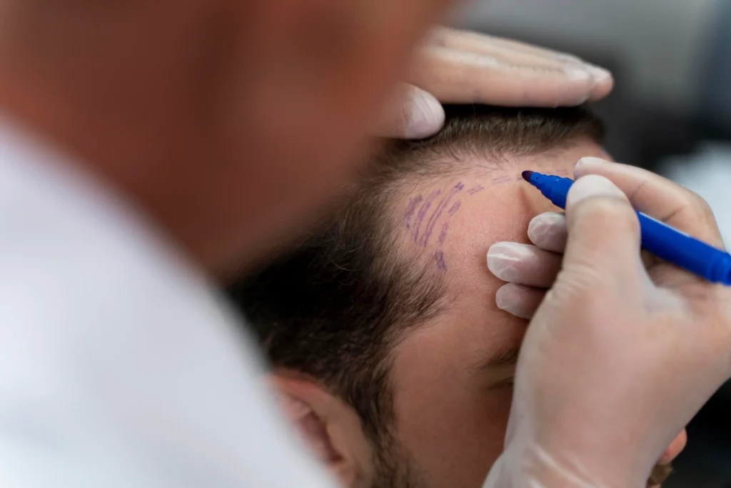 Greffe de cheveux et dermopigmentation capillaire : Mybodymoon s’associe à MDCC Hair Clinic